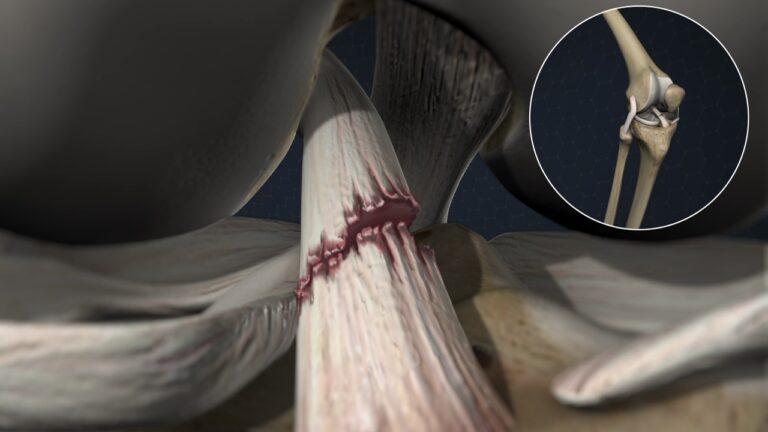 Ön Çapraz Bağ Yaralanması Fizik Tedavi