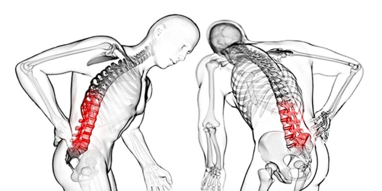 Ankilozan Spondilit (Kamburluk) Nedir? Belirtileri ve Tedavisi
