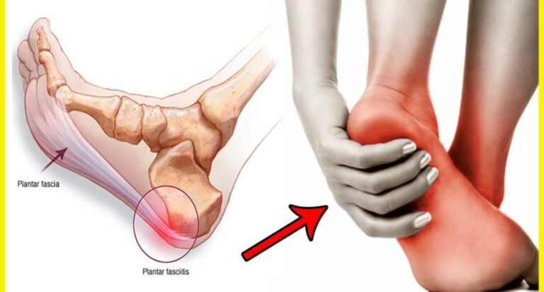 Plantar Fasiit Nedir?