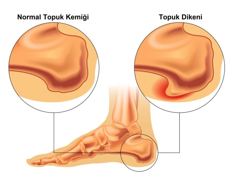 Topuk Dikeni Nedir? Belirti ve Tedavi Yöntemleri