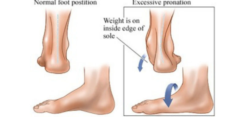 Pes Planus(düztaban) Nedir, Belirtileri, Tedavisi