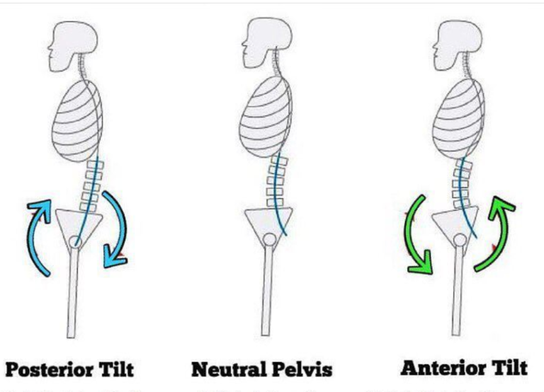 Posterior Pelvik Tilt Nedir? Duruş Bozuklukları Nedir? Posterior Pelvik Tilt Nedir? Duruş Bozuklukları Nedir?