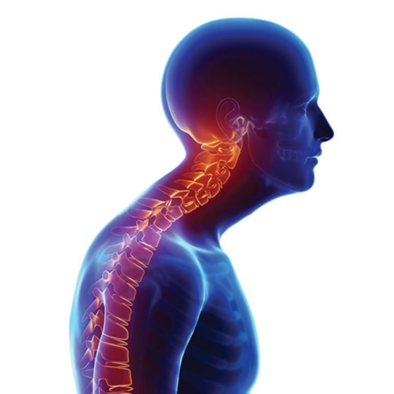 Postür(Duruş) Nedir? Postür Bozukluğu Nedir?